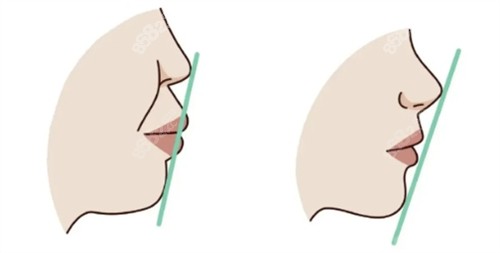 凸嘴矯正自測 凸嘴矯正自測