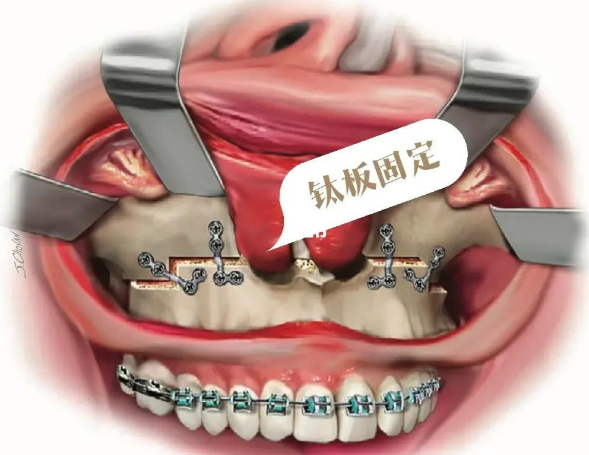 正頜手術(shù)何錦泉跟艾偉健哪個(gè)好