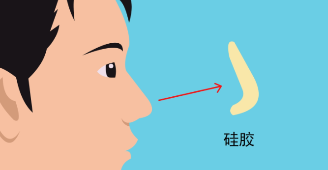 潘峰医生进行分段式隆鼻