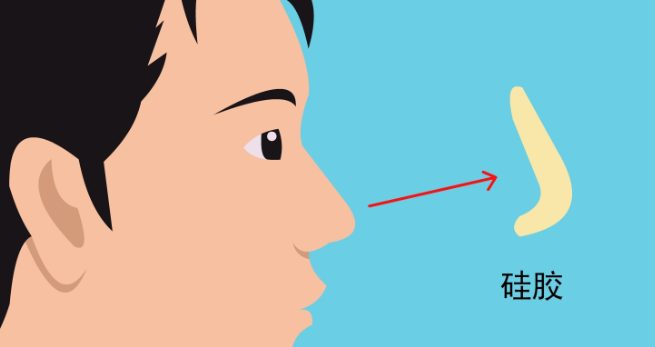 潘峰鼻整形收费透明度与合理性