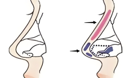 潘峰医生鼻整形技术对价格的影响