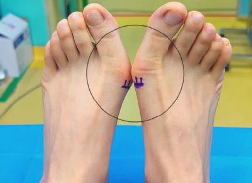 治療拇外翻好的醫(yī)生是誰？患者口碑TOP5：蘇敬達(dá)/李昕宇/曹海錕是大腳骨矯正的“老熟人”