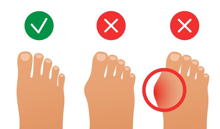 治疗拇外翻对比