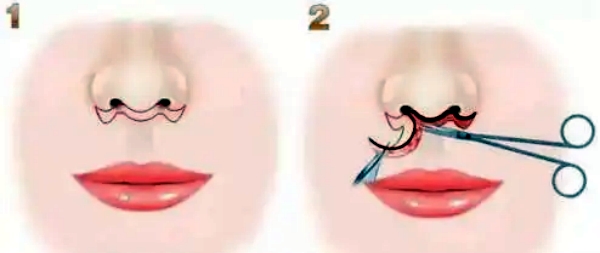 重慶橙尚醫(yī)療美容人中縮短