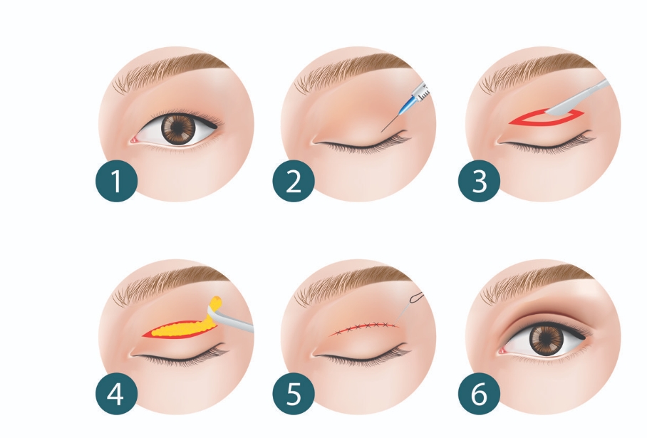 方濤醫(yī)生修復(fù)雙眼皮價格