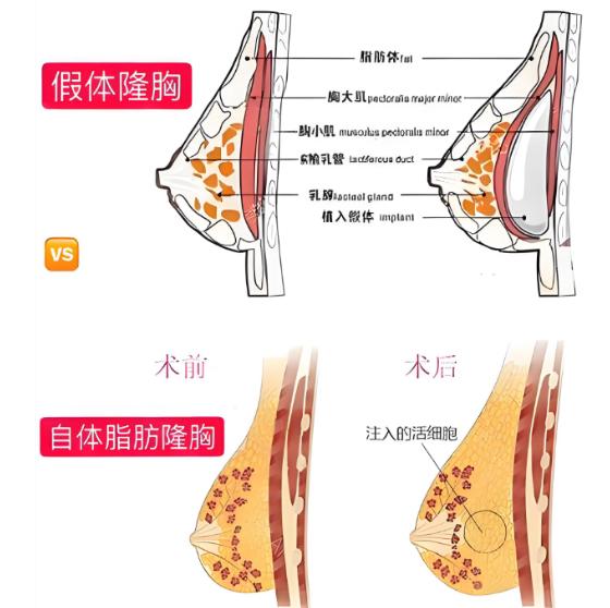 藝星假體隆胸實用攻略