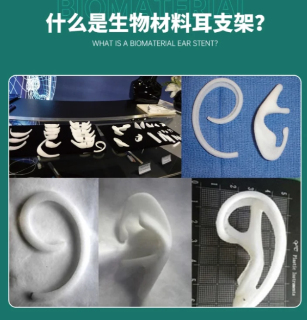 張正文耳畸形矯正費用