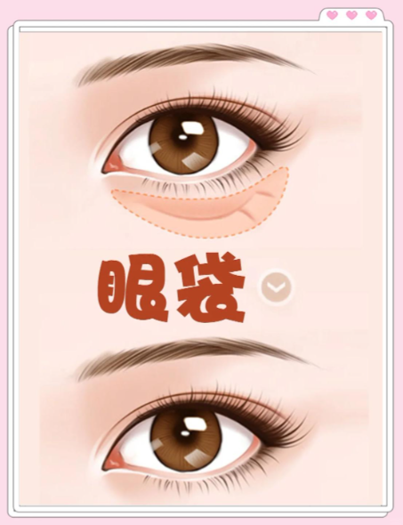 北京紫潔醫(yī)院做眼袋好的醫(yī)生名單