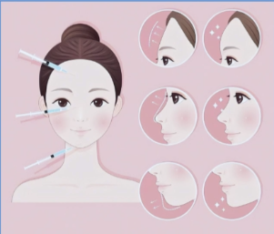 玻尿酸填充脸颊