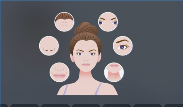 玻尿酸填充脸颊凹陷