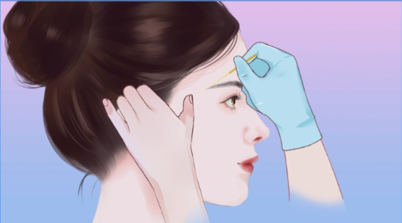 玻尿酸填充脸颊凹陷