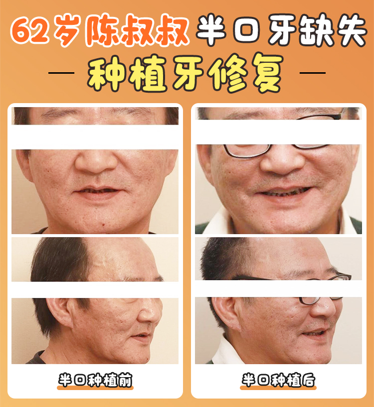 四、沈陽(yáng)德立聯(lián)合口腔醫(yī)院的特色項(xiàng)目——智能化種植修復(fù)