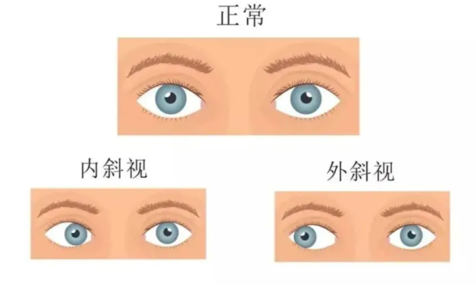 上海斜視科醫(yī)生姚靜和翟小妹哪個(gè)好？如何選擇合適的醫(yī)生