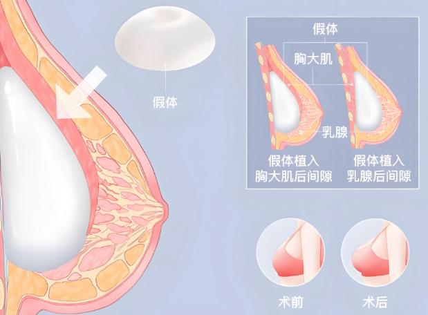內(nèi)窺鏡隆胸