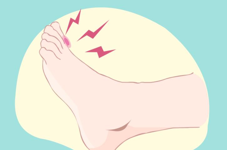 西安拇指外翻微创手术