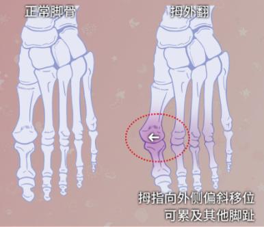 拇指外翻微创手术