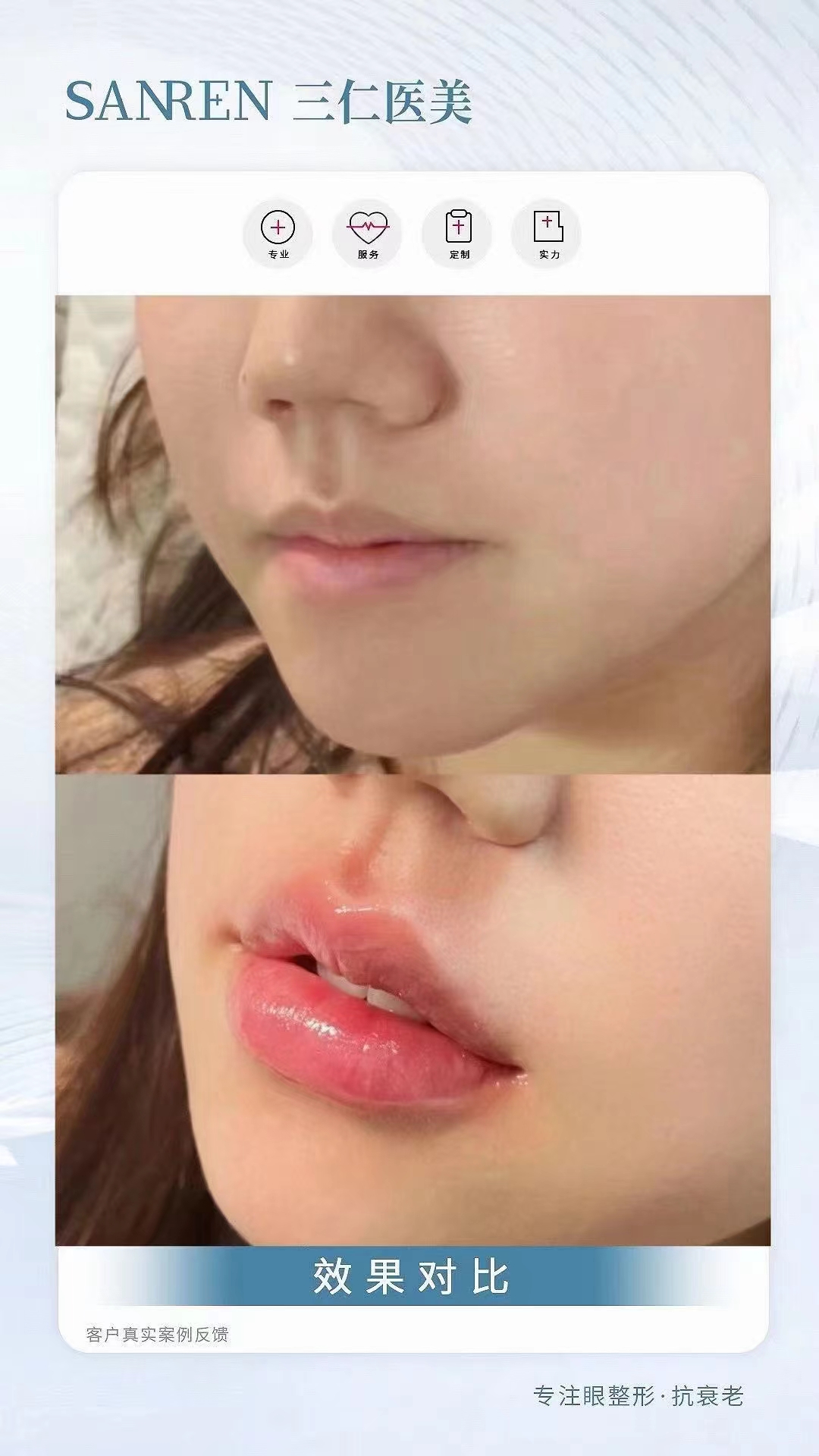 重慶藝星醫(yī)院：曼芙佳玻尿酸塑造幼態(tài)臉