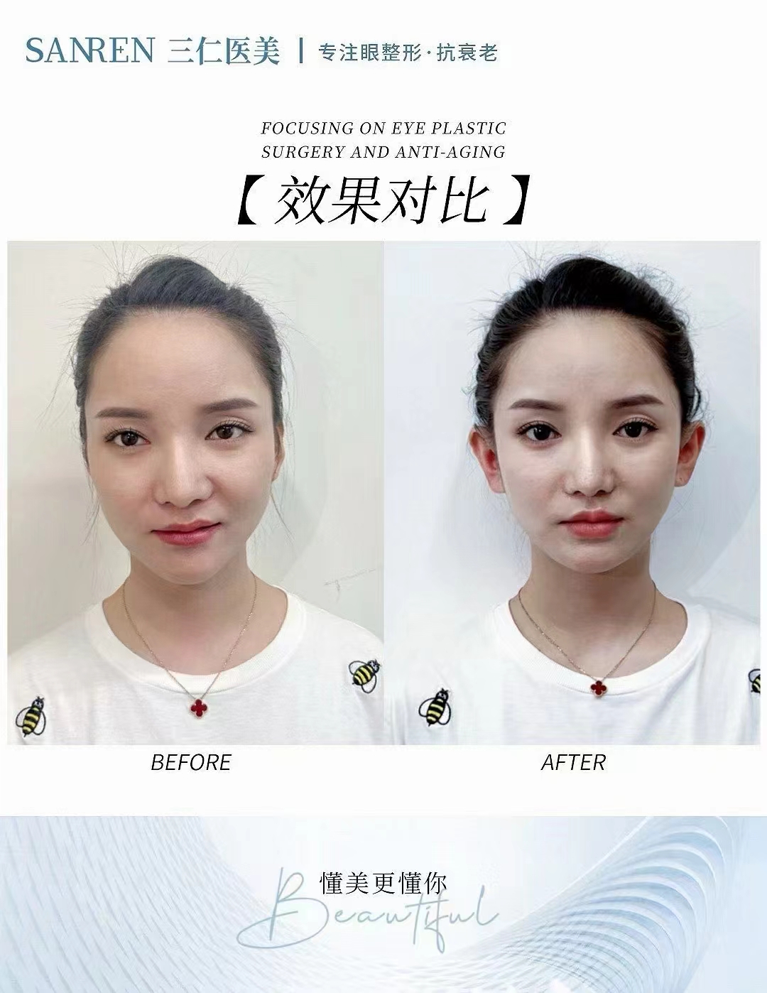 臺(tái)州藝星醫(yī)院：曼芙佳玻尿酸多樣選擇