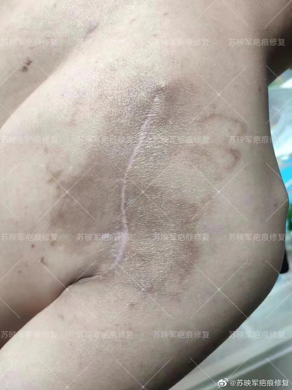 專精醫(yī)生為您的祛疤之路保駕護航