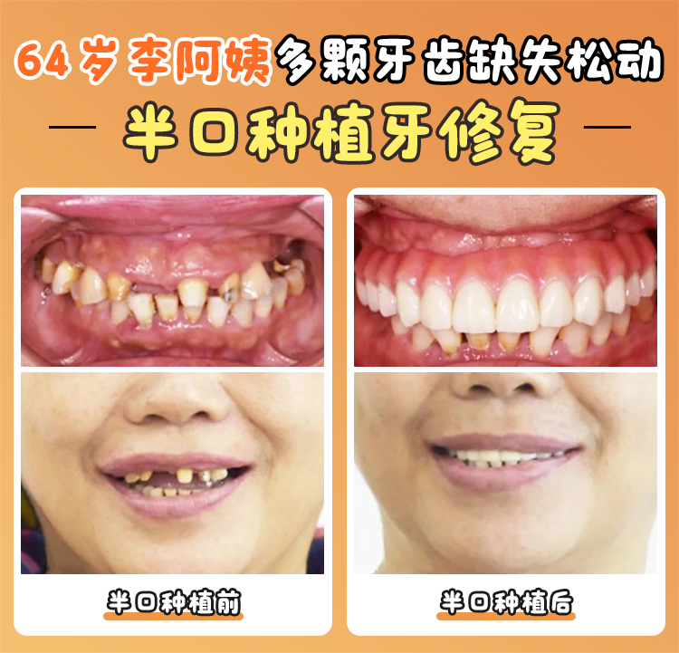 耒陽種植牙哪家好最靠譜？雅貝康口腔技術(shù)優(yōu)價(jià)格美，綠島口腔正畸超棒！ 