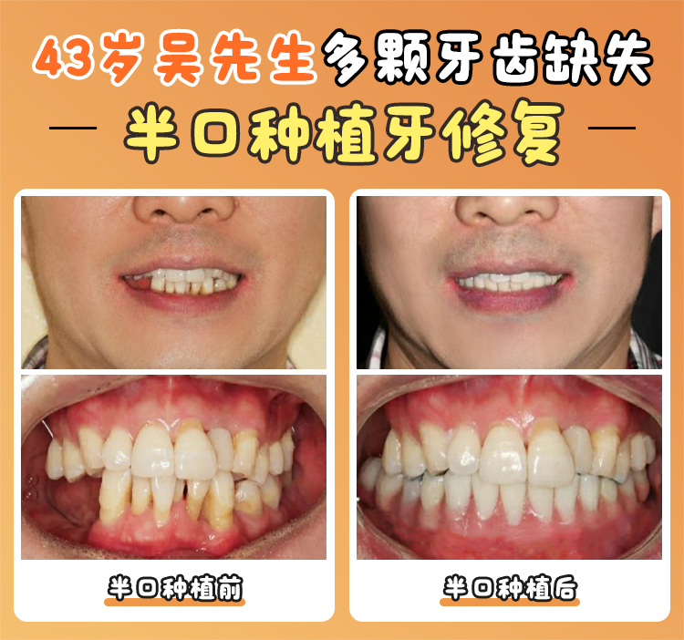 耒陽種植牙哪家好更靠譜？綠島口腔正畸超棒，矯正成效看得見！