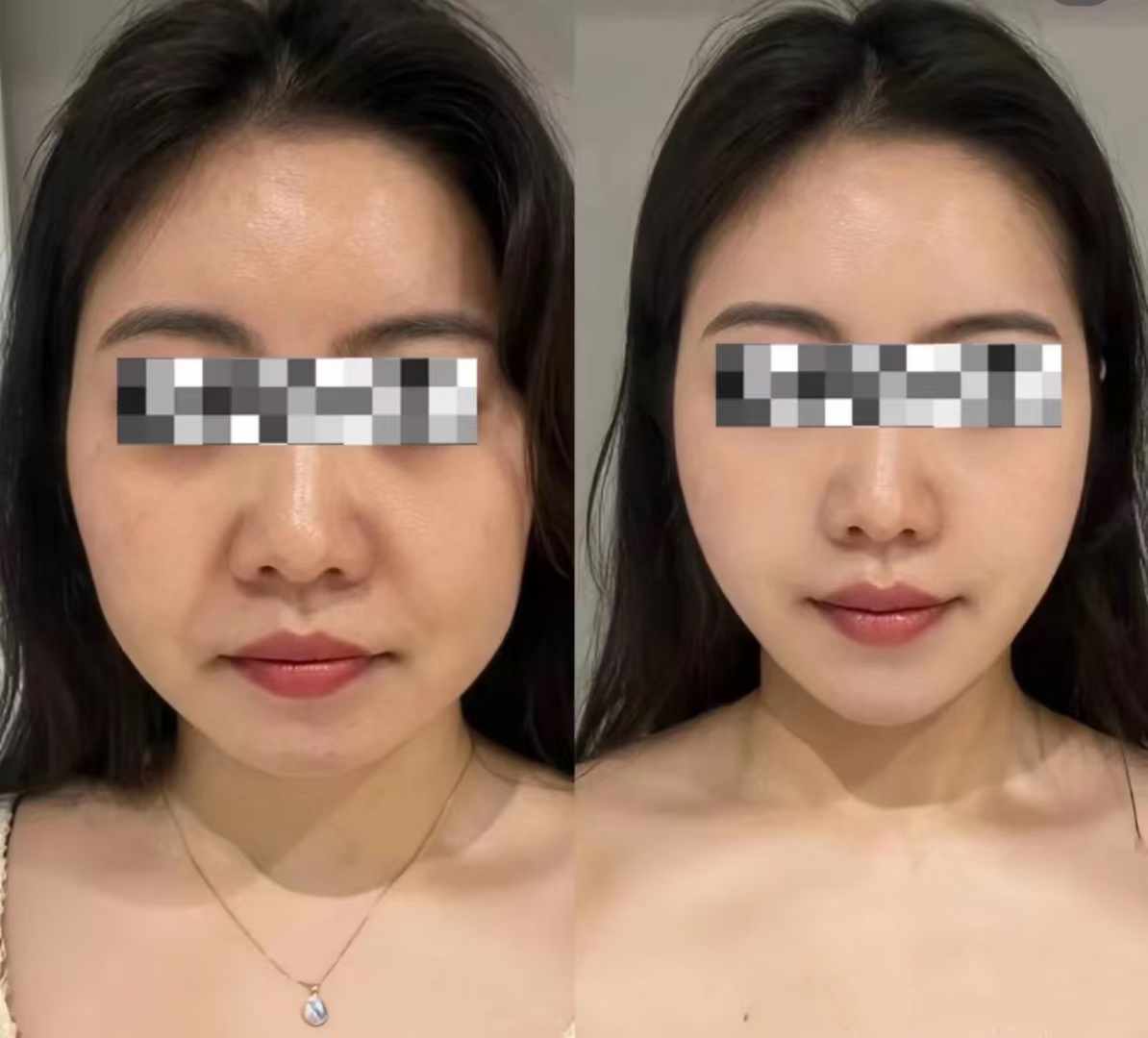 劉宇銅醫(yī)生除皺抗衰技術(shù)揭秘