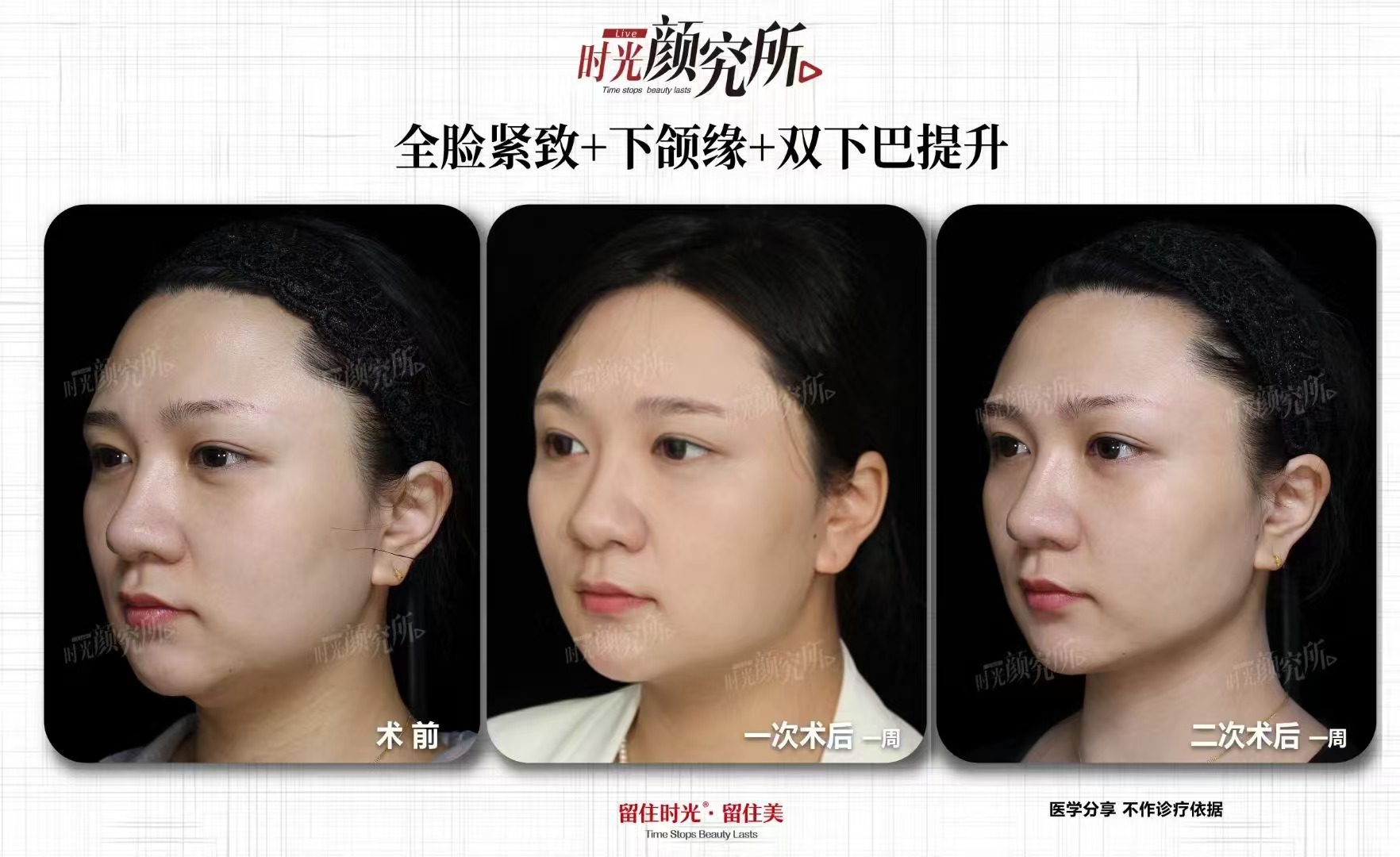 盧九寧醫(yī)生斜頸手術(shù)術(shù)后管理