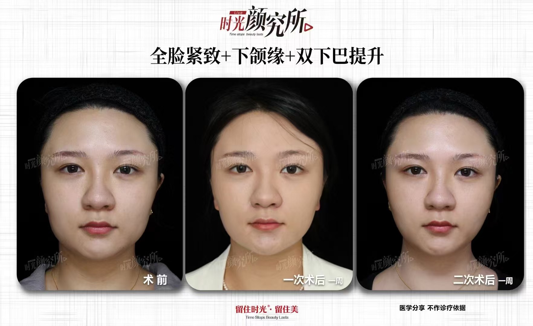 上海麗質(zhì)醫(yī)院斜頸矯正就診流程