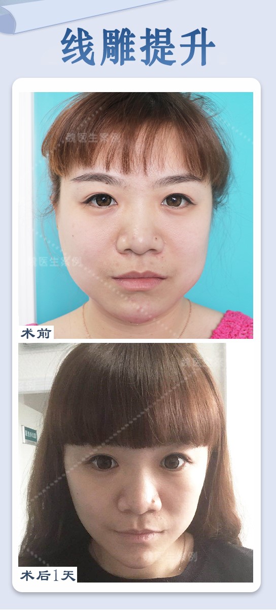 袁强拉皮：安心性与可靠性保护