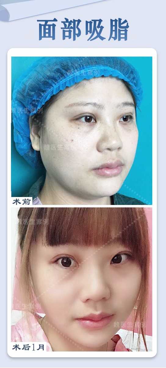 袁强拉皮：手术费用与坐诊医院介绍