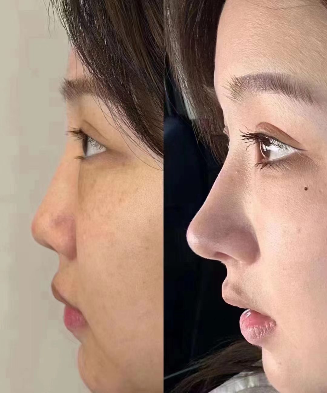 鄭州整形美容醫(yī)院張正文耳畸形整復(fù)價(jià)格貴嗎？