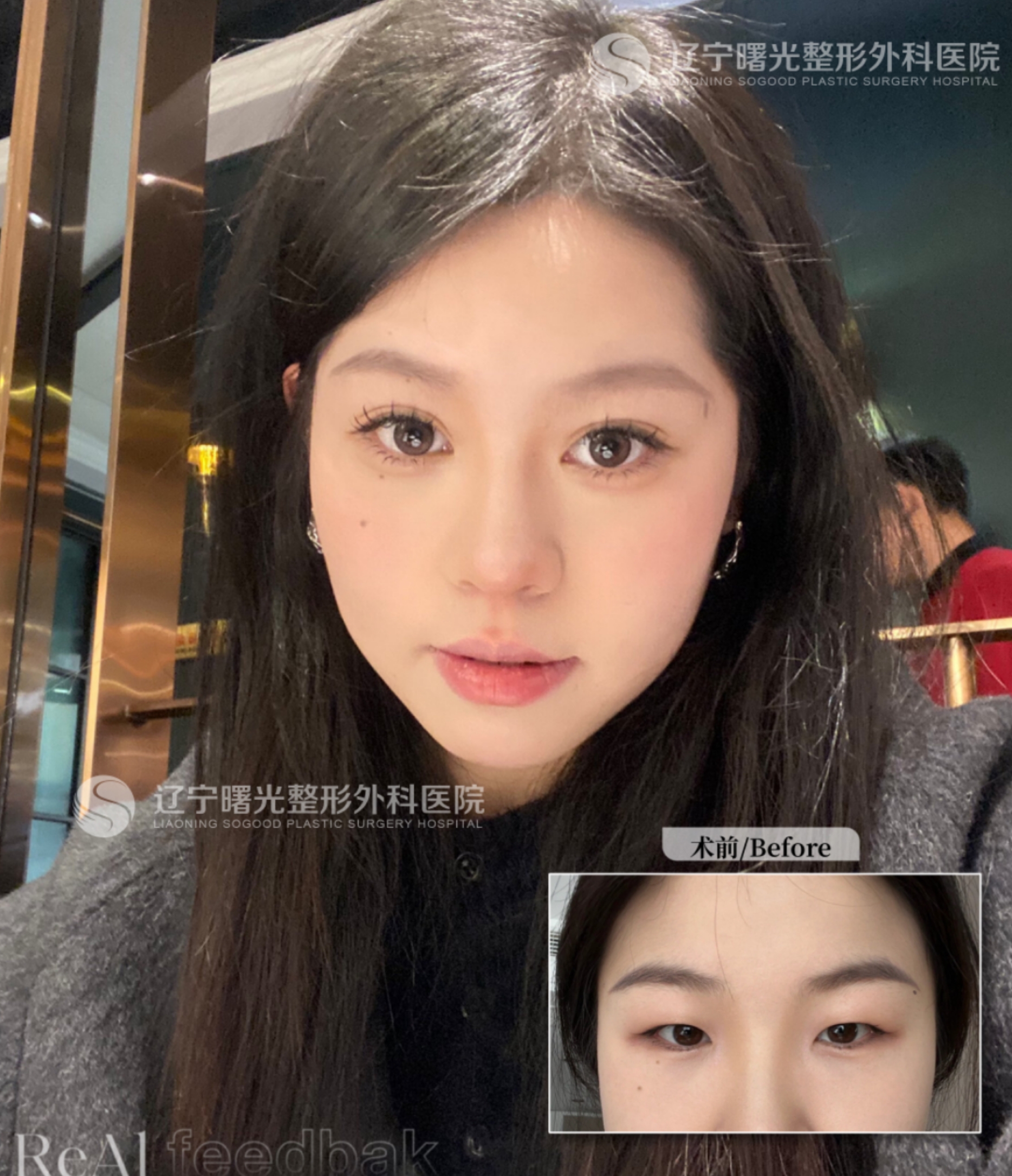 上海劉宇銀醫(yī)生：經驗多的眼部整形骨干醫(yī)生