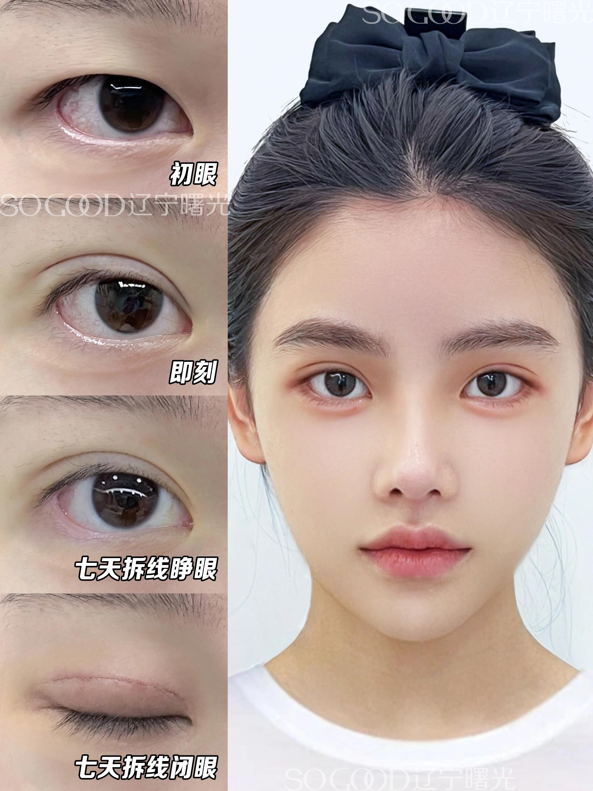 埋線雙眼皮：上海劉宇銀醫(yī)生的低價優(yōu)質之選