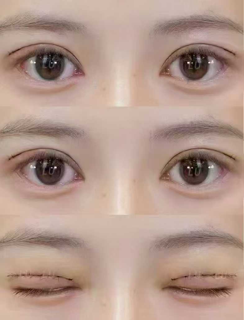 汕頭附二院整形美容科雙眼皮項目介紹及點評