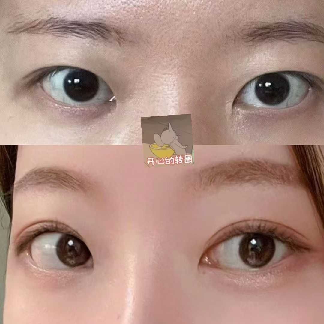 汕頭附二院整形美容科隆鼻項目介紹及點評