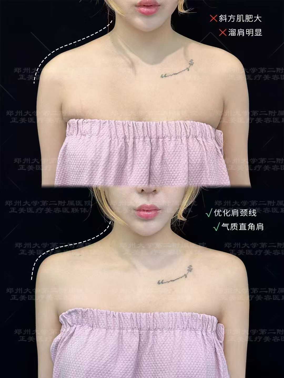 鄭州整形美容醫(yī)院張正文耳畸形整復(fù) 3D 打印技術(shù)優(yōu)勢(shì)在哪？