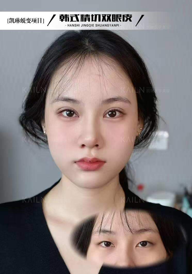 汕頭附二院整形美容科實例分享