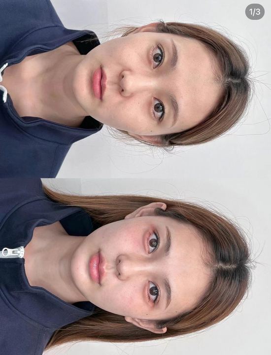 北京加減美拉皮手術(shù)情況