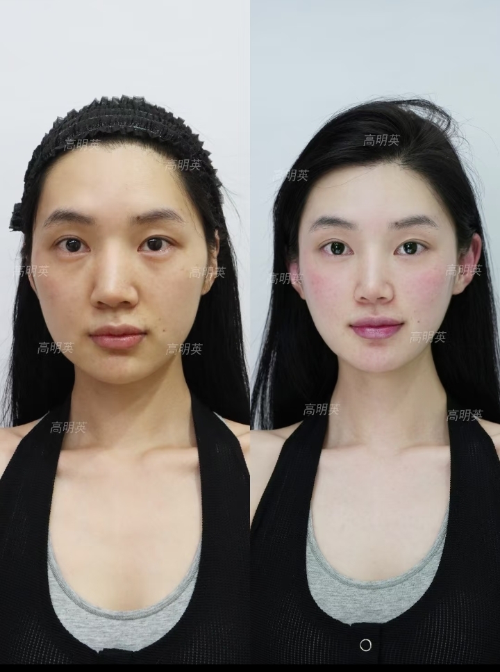 廣州中家醫(yī)家庭醫(yī)生拉皮手術(shù)情況