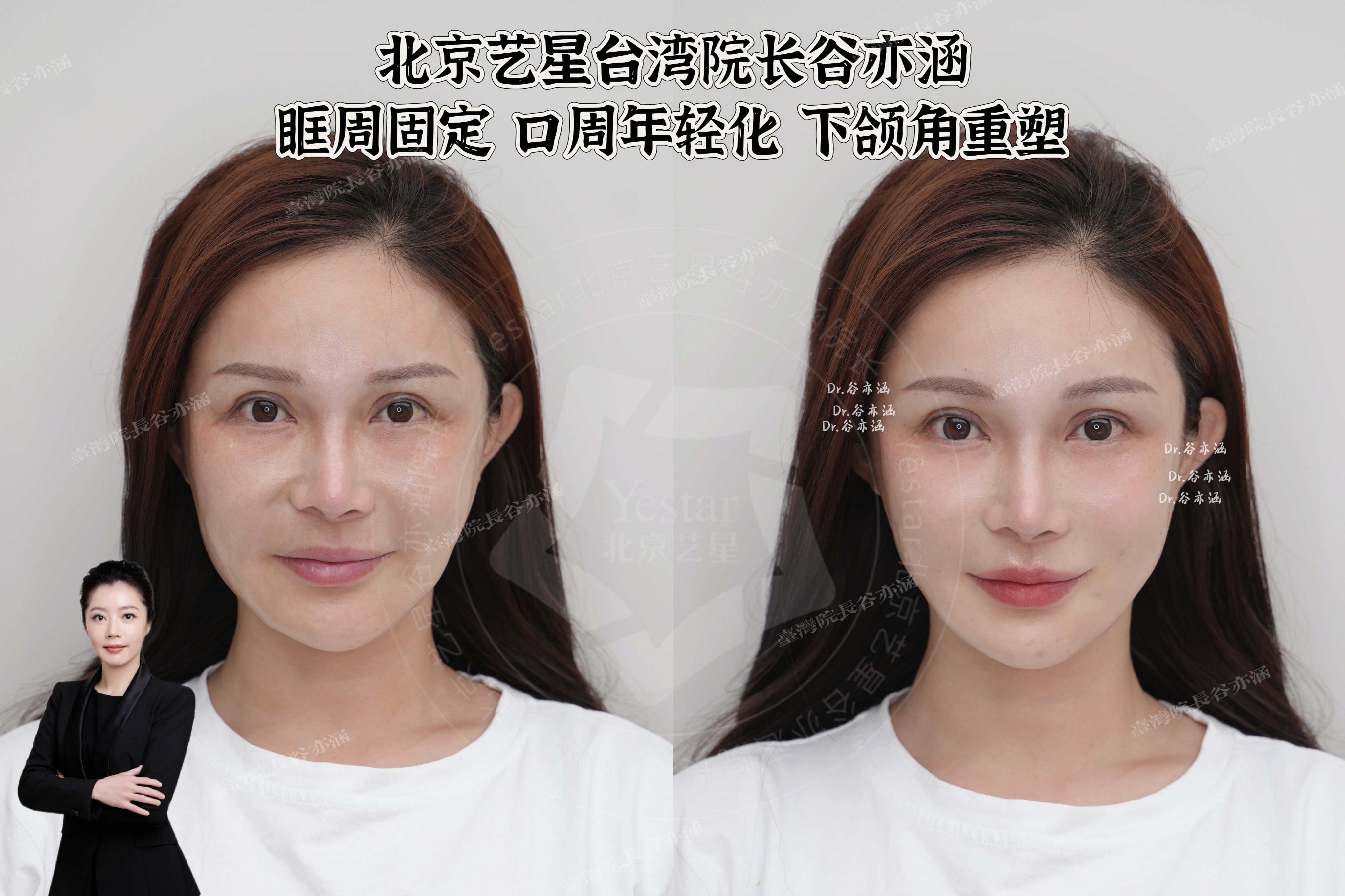 西安國醫(yī)整形醫(yī)院拉皮手術(shù)情況