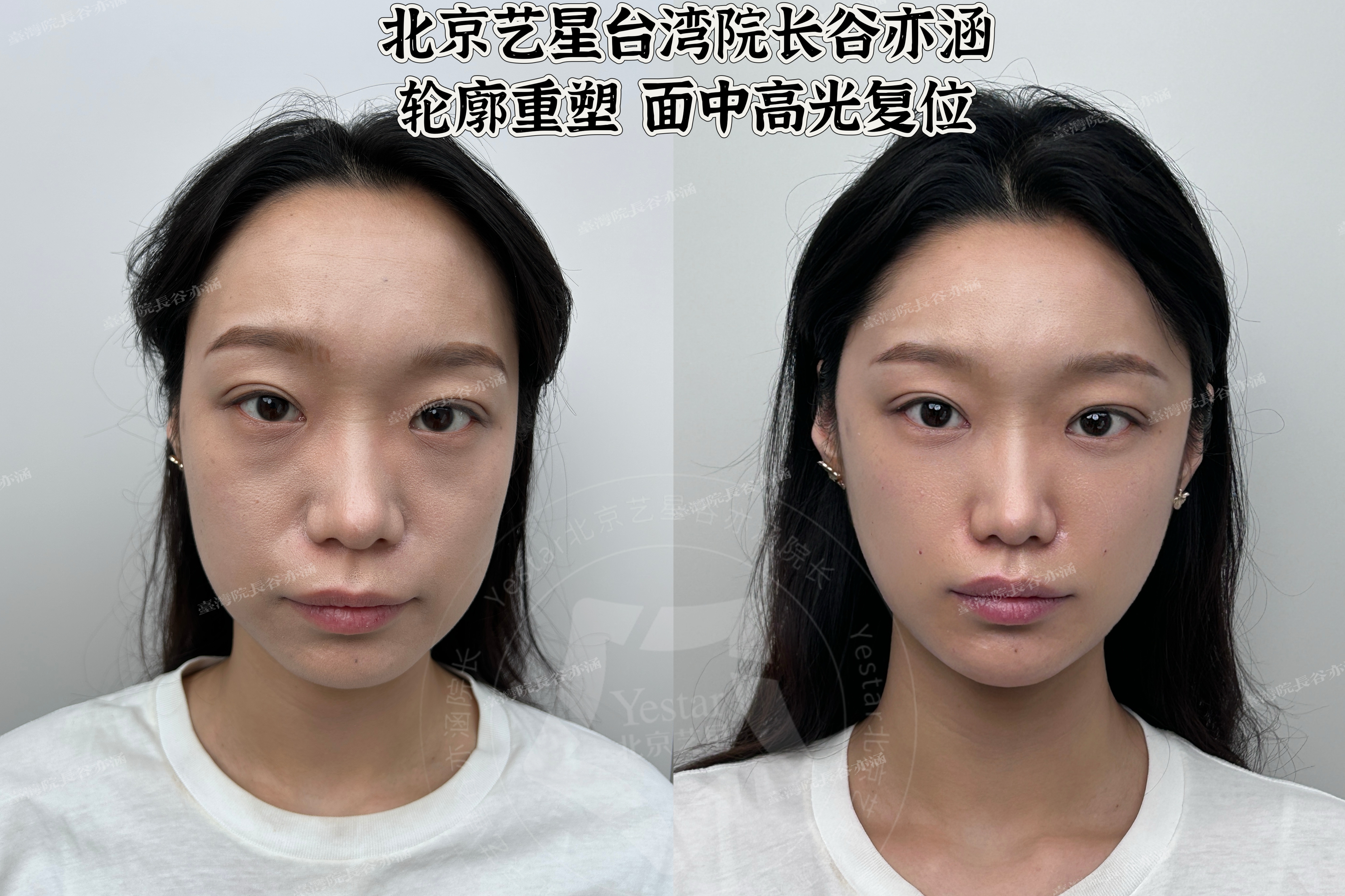 重慶軍科整形美容醫(yī)院拉皮手術(shù)情況