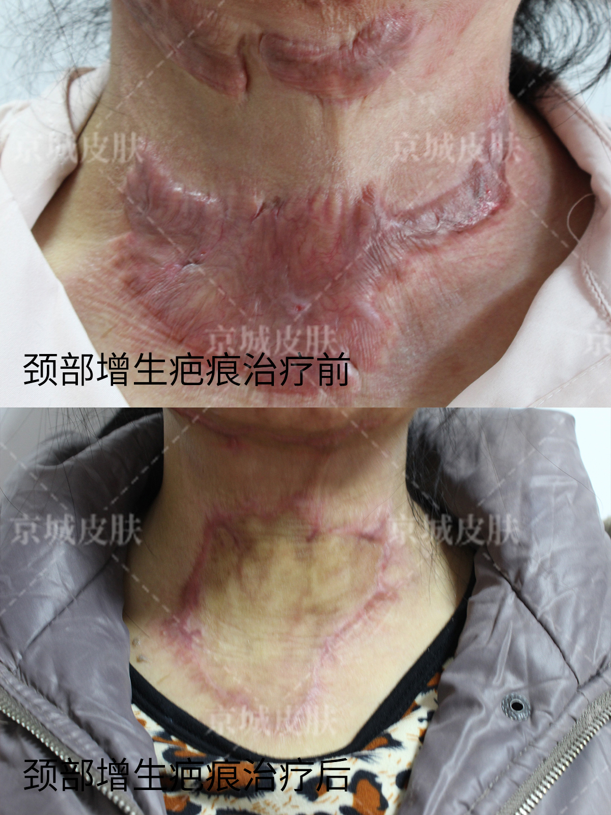 四川紫馨醫(yī)學(xué)美容醫(yī)院拉皮手術(shù)情況