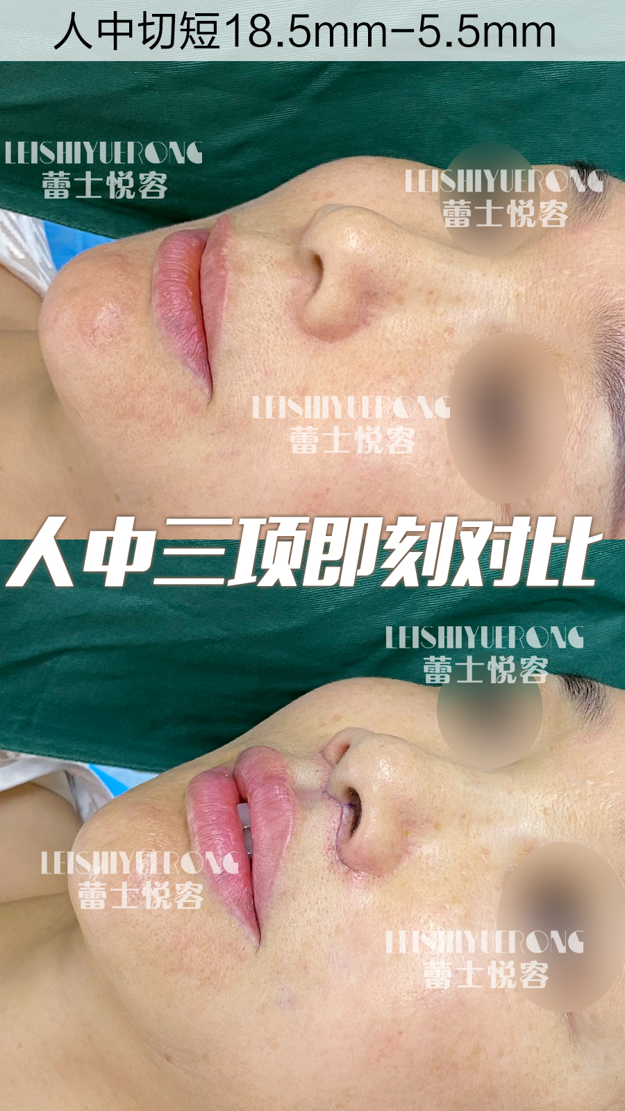 上海盧玲醫(yī)生雙眼皮修復(fù)價(jià)格詳情