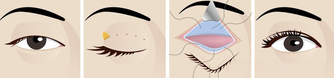 整形项目选择与注意事项