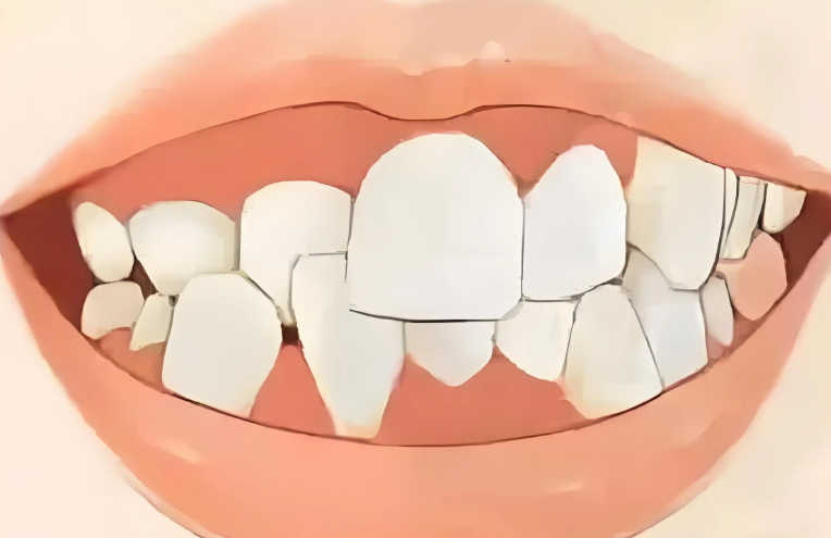 北京極簡口腔種植牙有什么優(yōu)勢?家園/三元橋院都有智慧導航，選韓國受騰才5500一口價|智慧導航精準種牙+韓系一口價，微創(chuàng)舒適高性價比