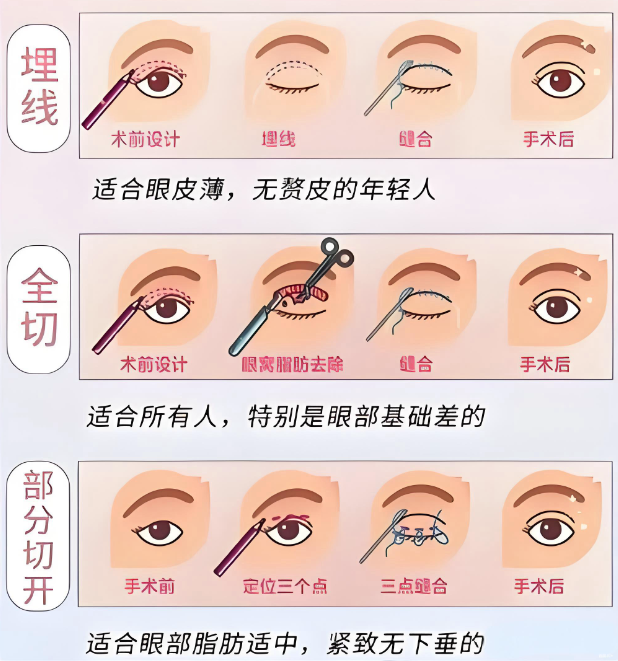 北京印正山雙眼皮修復(fù)實(shí)例參考：從“肉條眼”到自然媽生款，她花了2.8萬(wàn)值嗎？