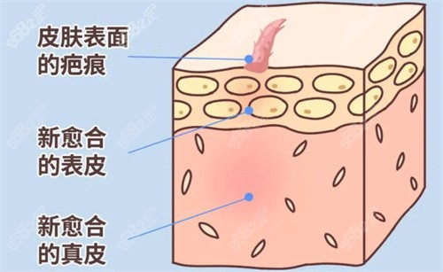 疤痕的形成過程 疤痕的形成過程