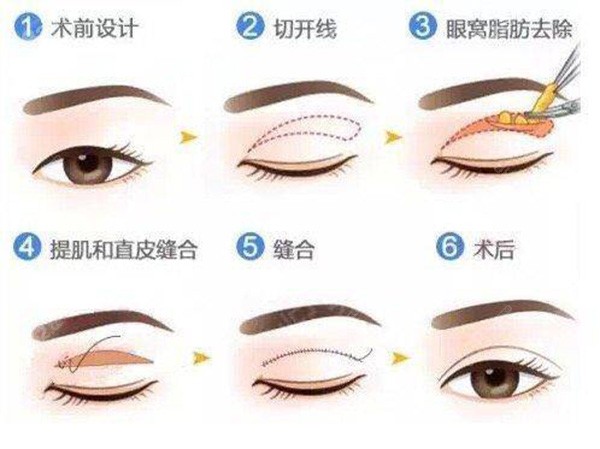 西安張沙沙雙眼皮案例揭秘！4800元起get媽生感雙眼，閉眼無痕超驚艷！