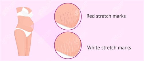 妊娠疤痕 妊娠疤痕
