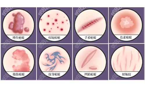疤痕的種類展示 疤痕的種類展示